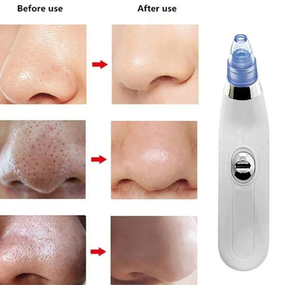 4 In 1 Pore Cleansing Detox Tool